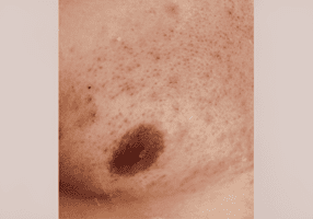 Skin showing red bumps, a normal histamine reaction after waxing or sugaring